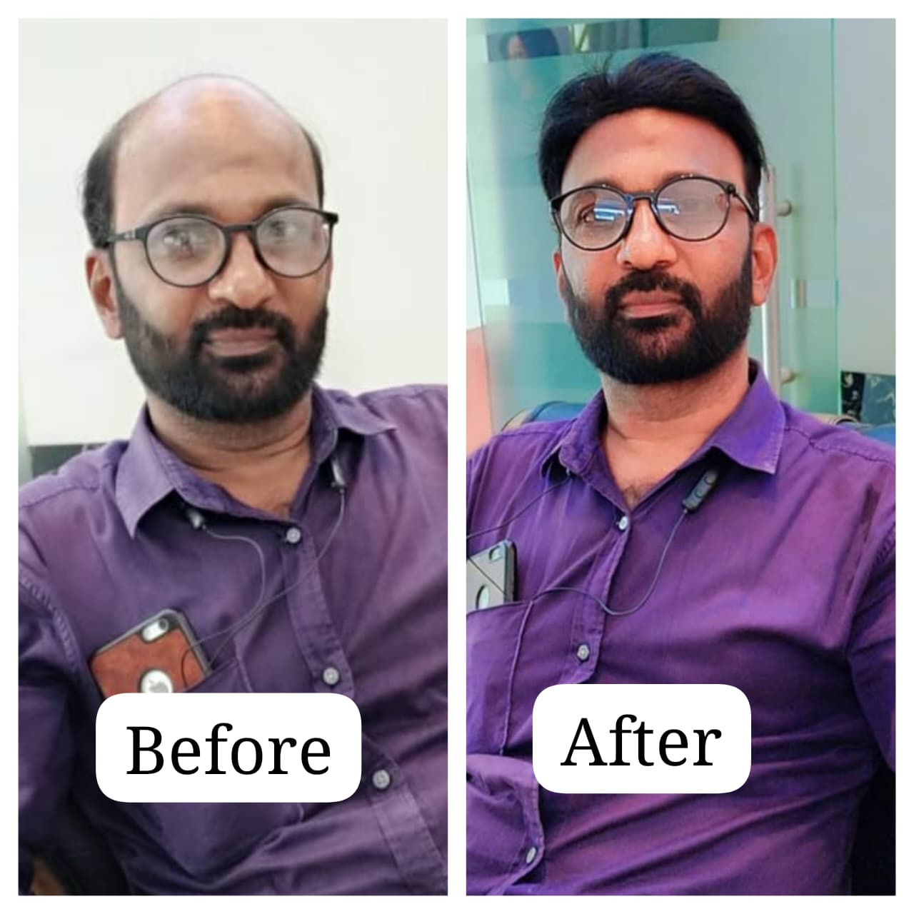 Premium hair patch solutions at GetHair Chennai